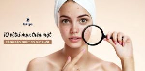 10 vị trí mụn trên mặt cảnh báo nguy cơ sức khỏe